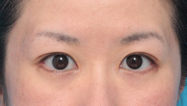 症例写真,目尻切開+たれ目形成術(グラマラスライン)で目を外側と下方に大きくした症例写真,4ヶ月後,mainpic_panda06d.jpg
