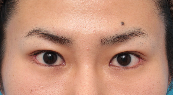 症例写真,目尻切開+タレ目形成(グラマラスライン)で目を一回り大きくした男性の症例写真の術前術後画像,After(6ヶ月後),ba_panda07_b.jpg