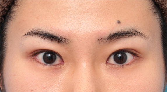 症例写真,目尻切開+タレ目形成(グラマラスライン)で目を一回り大きくした男性の症例写真の術前術後画像,Before,ba_panda07_b.jpg
