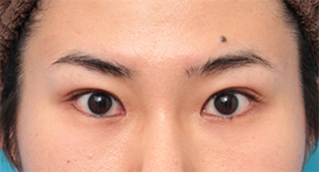 症例写真,目尻切開+タレ目形成(グラマラスライン)で目を一回り大きくした男性の症例写真の術前術後画像,手術前,mainpic_panda07a.jpg