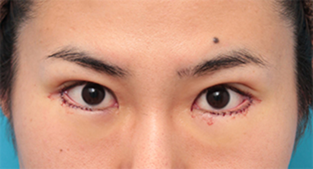 症例写真,目尻切開+タレ目形成(グラマラスライン)で目を一回り大きくした男性の症例写真の術前術後画像,手術直後,mainpic_panda07b.jpg