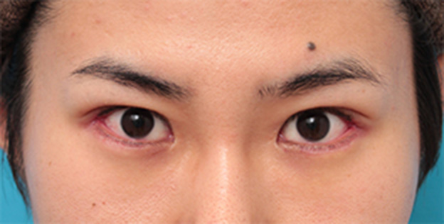 症例写真,目尻切開+タレ目形成(グラマラスライン)で目を一回り大きくした男性の症例写真の術前術後画像,1週間後,mainpic_panda07c.jpg