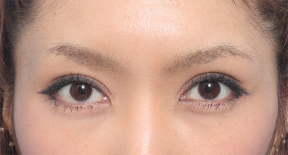症例写真,他院で非常に幅の広い二重を全切開法で作り、幅を狭く修正した症例写真(失敗手術の修正),After(メイクあり)<br/>
(6ヶ月後),