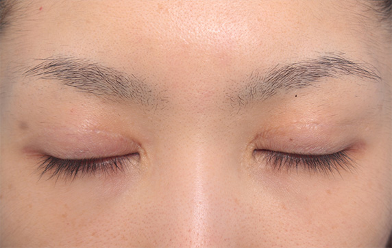 症例写真,他院で非常に幅の広い二重を全切開法で作り、幅を狭く修正した症例写真(失敗手術の修正),After(目を閉じた状態)<br/>
(6ヶ月後),ba_modify02_b.jpg