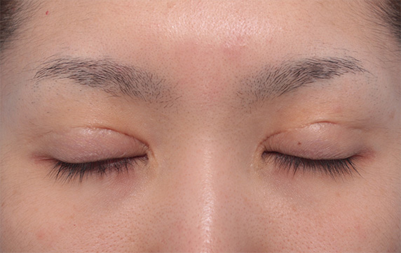 症例写真,他院で非常に幅の広い二重を全切開法で作り、幅を狭く修正した症例写真(失敗手術の修正),Before,ba_modify02_b.jpg
