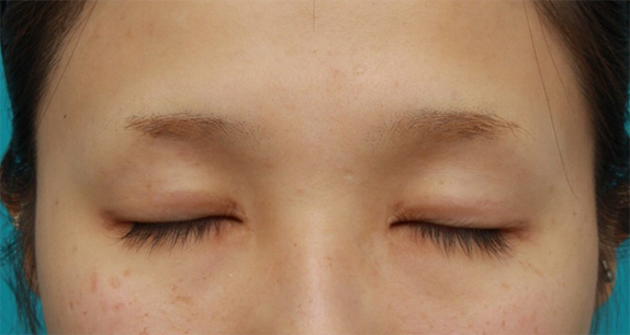 症例写真,他院の全切開法で幅広く作られた二重まぶたを幅狭く修正手術した症例写真,After(6ヶ月後),ba_modify05_b.jpg