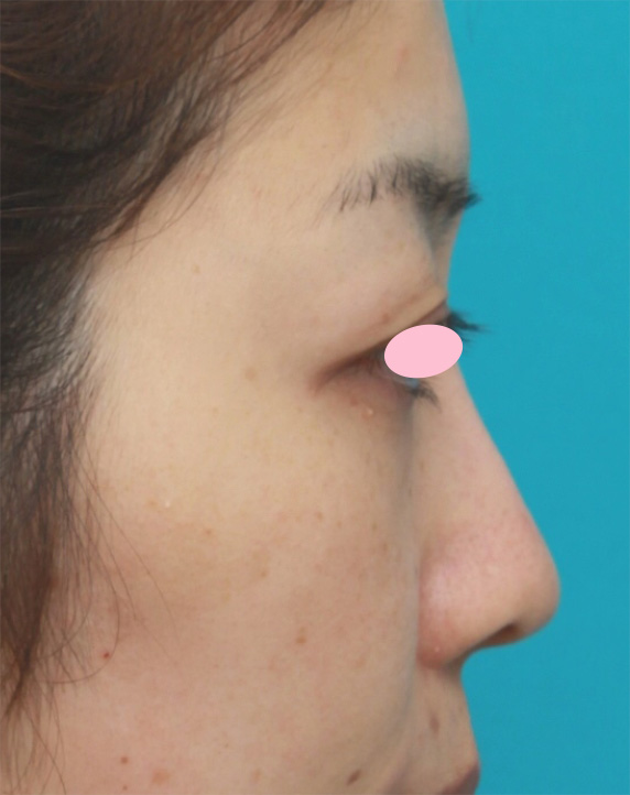 症例写真,耳介軟骨移植で丸い鼻先を斜め下方向に綺麗に出した20代女性の症例写真の術前術後画像,After(6ヶ月後),ba_jikai43_b.jpg