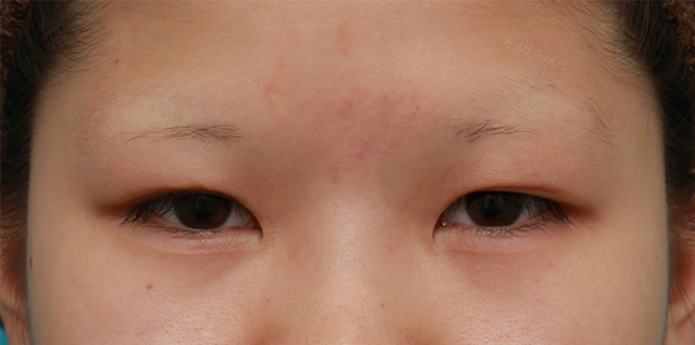 他院で受けた手術の修正(二重まぶた・目もと),二重まぶた全切開法を受けた後、元に戻ってしまったため、再び切開して修正した症例写真の術前術後画像,手術前,mainpic_modify04a.jpg
