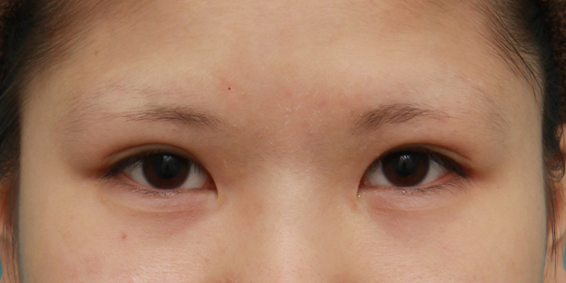 他院で受けた手術の修正(二重まぶた・目もと),二重まぶた全切開法を受けた後、元に戻ってしまったため、再び切開して修正した症例写真の術前術後画像,6ヶ月後,mainpic_modify04e.jpg