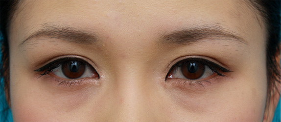 眼瞼下垂(がんけんかすい),他院で行った切開二重を眼瞼下垂手術で修正し目頭切開も行いハーフっぽい印象になった症例写真,After(メイクあり),