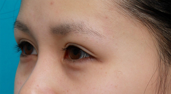 眼瞼下垂(がんけんかすい),他院で行った切開二重を眼瞼下垂手術で修正し目頭切開も行いハーフっぽい印象になった症例写真,After(メイクなし),ba_ganken37_b.jpg