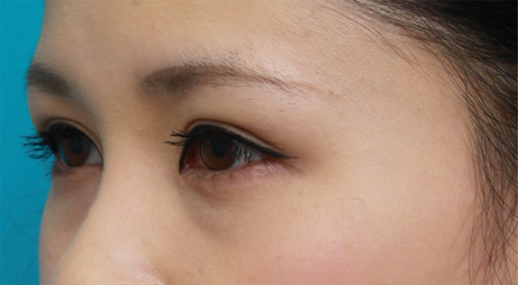 眼瞼下垂(がんけんかすい),他院で行った切開二重を眼瞼下垂手術で修正し目頭切開も行いハーフっぽい印象になった症例写真,After(メイクあり),