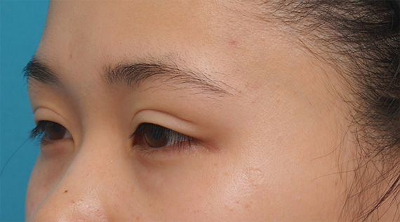 眼瞼下垂(がんけんかすい),他院で行った切開二重を眼瞼下垂手術で修正し目頭切開も行いハーフっぽい印象になった症例写真,Before,ba_ganken37_b.jpg