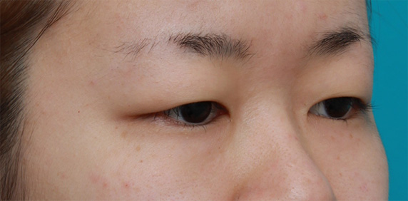 眼瞼下垂(がんけんかすい),非常に厚ぼったい一重まぶたに対して、大量の脂肪を切除して眼瞼下垂手術を行った症例写真,Before,ba_ganken39_b.jpg
