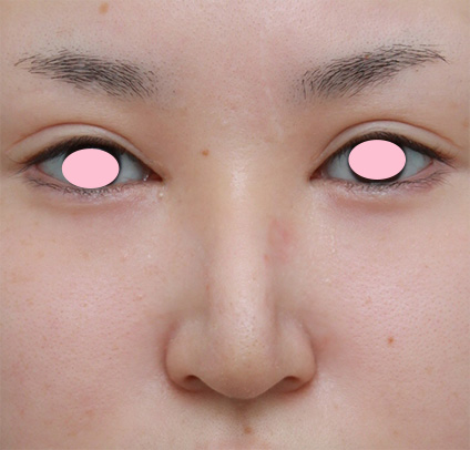 症例写真,鼻尖形成手術でダンゴ鼻を細くした症例写真,After(3ヶ月後),ba_bisen20_b.jpg