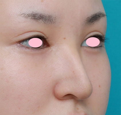 症例写真,鼻尖形成手術でダンゴ鼻を細くした症例写真,After(3ヶ月後),ba_bisen21_b.jpg