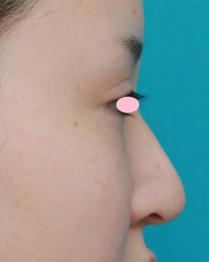 症例写真,鼻尖形成手術でダンゴ鼻を細くした症例写真,After(3ヶ月後),ba_bisen22_b.jpg