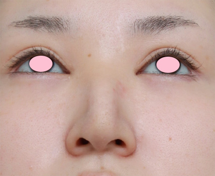 症例写真,鼻尖形成手術でダンゴ鼻を細くした症例写真,After(3ヶ月後),ba_bisen23_b.jpg