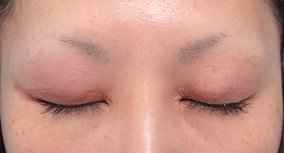 症例写真,他院で行われた二重まぶた切開法に対し、眼瞼下垂手術で二重の幅を狭く修正した症例写真,After(4ヶ月後),ba_ganken43_b.jpg