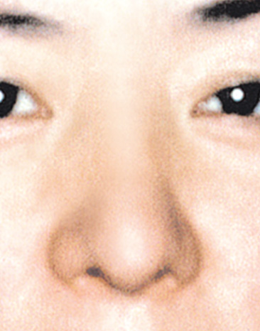 症例写真,鼻尖形成(鼻尖縮小・だんご鼻修正)の症例写真,After,ba_bisen08_b.jpg