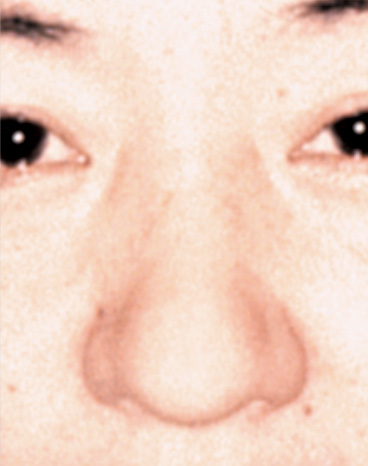 症例写真,鼻尖形成(鼻尖縮小・だんご鼻修正)の症例写真,Before,ba_bisen08_b.jpg