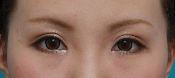 眼瞼下垂(がんけんかすい),目頭切開+眼瞼下垂手術の症例写真,After(メイクあり)<br/>
(6ヶ月後),