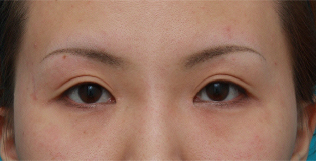 眼瞼下垂（がんけんかすい）,目頭切開+眼瞼下垂手術の症例写真,6ヶ月後,メイクなし,mainpic_ganken09e.jpg