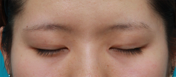 眼瞼下垂(がんけんかすい),目頭切開+眼瞼下垂手術で小さい目を一回り大きくした症例写真,After(目を閉じた状態)<br/>
(6ヶ月後),