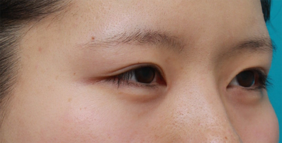 眼瞼下垂(がんけんかすい),目頭切開+眼瞼下垂手術で小さい目を一回り大きくした症例写真,After(6ヶ月後),ba_ganken46_b.jpg