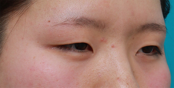 眼瞼下垂(がんけんかすい),目頭切開+眼瞼下垂手術で小さい目を一回り大きくした症例写真,Before,ba_ganken46_b.jpg