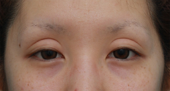 他院で切開法で非常に幅の広い二重を作り失敗し、眼瞼下垂手術で幅を狭く修正した症例写真,Before,ba_ganken49_b.jpg