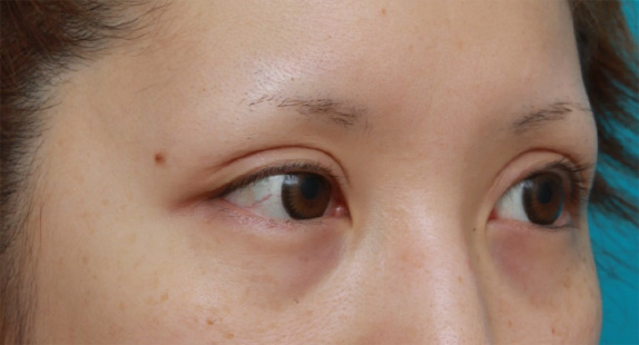 症例写真,他院で切開法で非常に幅の広い二重を作り失敗し、眼瞼下垂手術で幅を狭く修正した症例写真,After(4ヶ月後),ba_ganken50_b.jpg