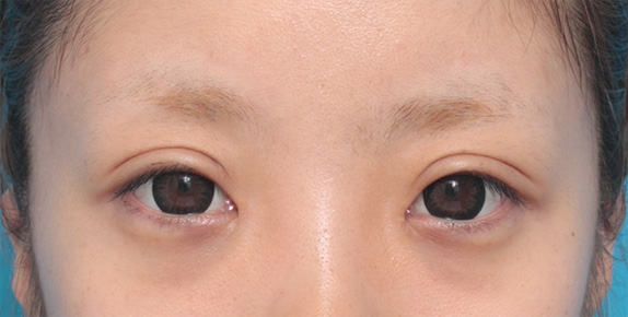眼瞼下垂(がんけんかすい),目頭切開+眼瞼下垂手術で小さい目を大きくした症例写真,After(カラコンあり),
