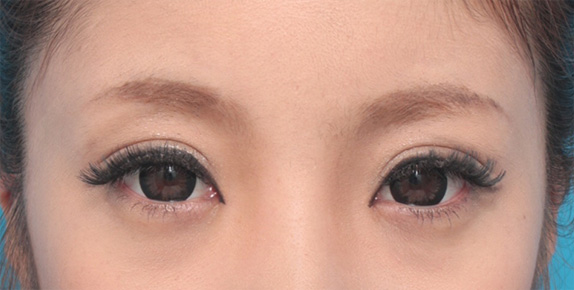 眼瞼下垂(がんけんかすい),目頭切開+眼瞼下垂手術で小さい目を大きくした症例写真,After(カラコン、メイクあり)<br/>
(6ヶ月後),