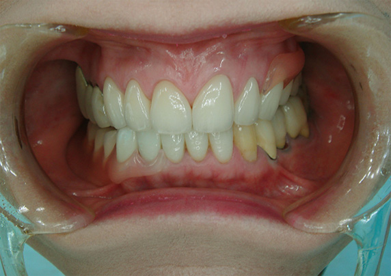 症例写真,義歯・入れ歯の症例写真 オールセラミッククラウン(e-max)も施行,After,ba_denture01_b.jpg