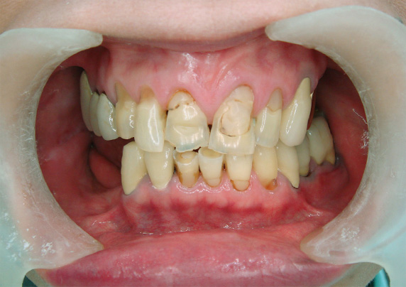 症例写真,義歯・入れ歯の症例写真 オールセラミッククラウン(e-max)も施行,Before,ba_denture01_b.jpg
