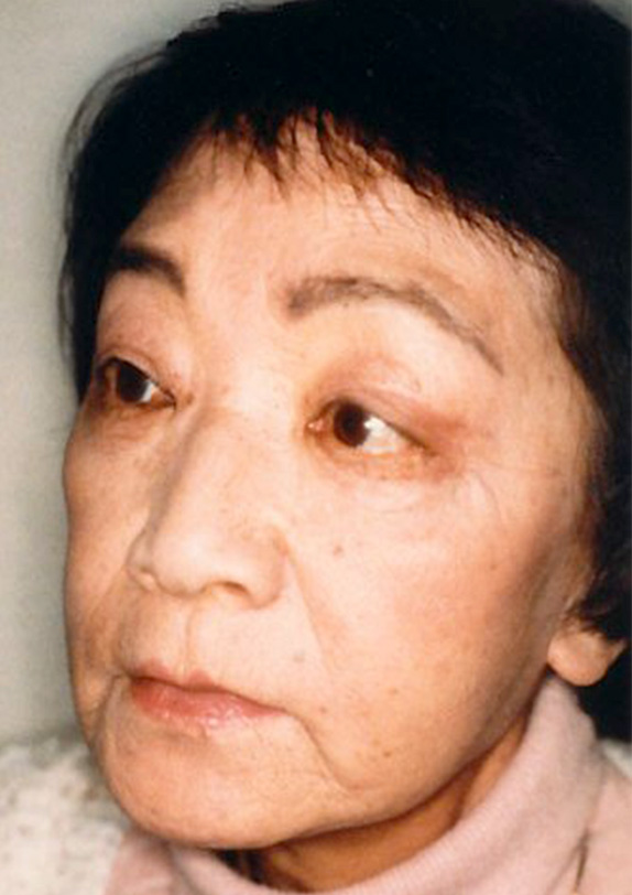 フルフェイスリフト,フルフェイスリフトの症例写真 額リフト(額のしわ取り手術)も施行,After,ba_facelift_pic08_b.jpg