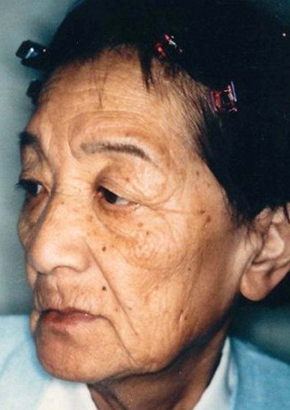 フルフェイスリフト,フルフェイスリフトの症例写真 額リフト(額のしわ取り手術)も施行,Before,ba_facelift_pic08_b.jpg