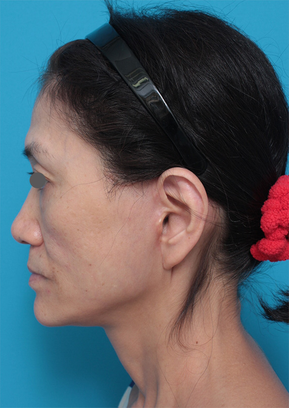 症例写真,50代女性に行ったミディアムフェイスリフト症例写真,After(2ヶ月後),ba_mediumlift_pic11_b.jpg