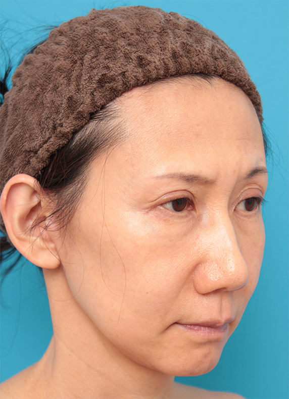 ミディアムフェイスリフト,40代女性のミディアムフェイスリフト症例写真,After(6ヶ月後),ba_mediumlift13_b.jpg