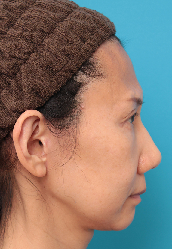 ミディアムフェイスリフト,40代女性のミディアムフェイスリフト症例写真,After(6ヶ月後),ba_mediumlift14_b.jpg