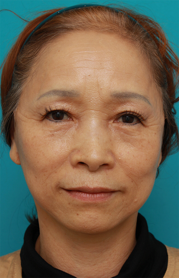症例写真,60代女性に行ったミニフェイスリフト(頬のたるみ取り)症例写真,After(1ヶ月後),ba_minilift_pic17a_b.jpg