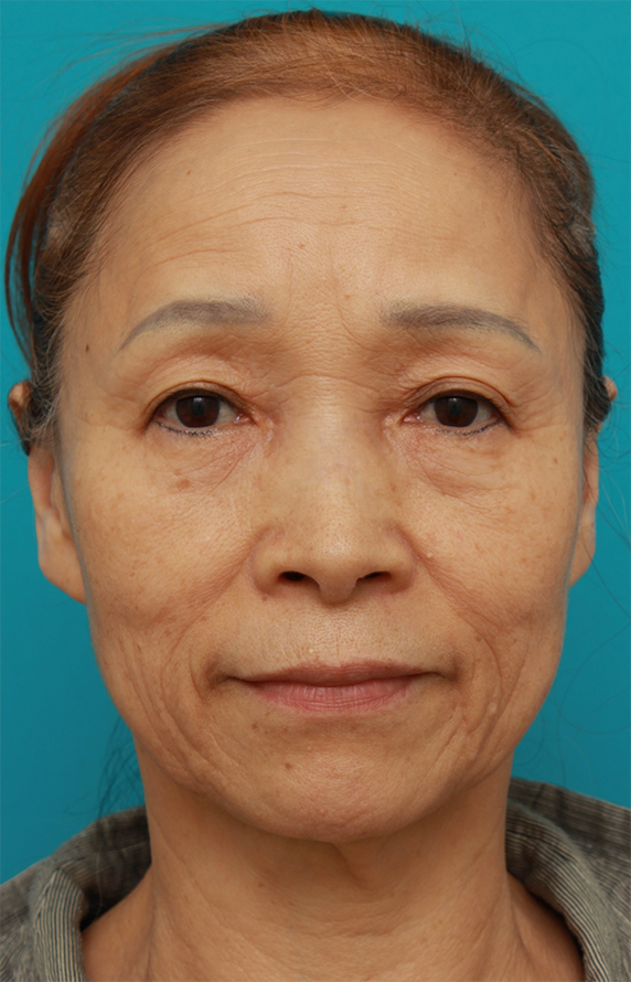 症例写真,60代女性に行ったミニフェイスリフト(頬のたるみ取り)症例写真,Before,ba_minilift_pic17a_b.jpg