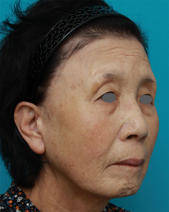 症例写真,60代女性に行ったミニフェイスリフト(頬のたるみ取り)の症例写真,Before,ba_minilift19_b.jpg