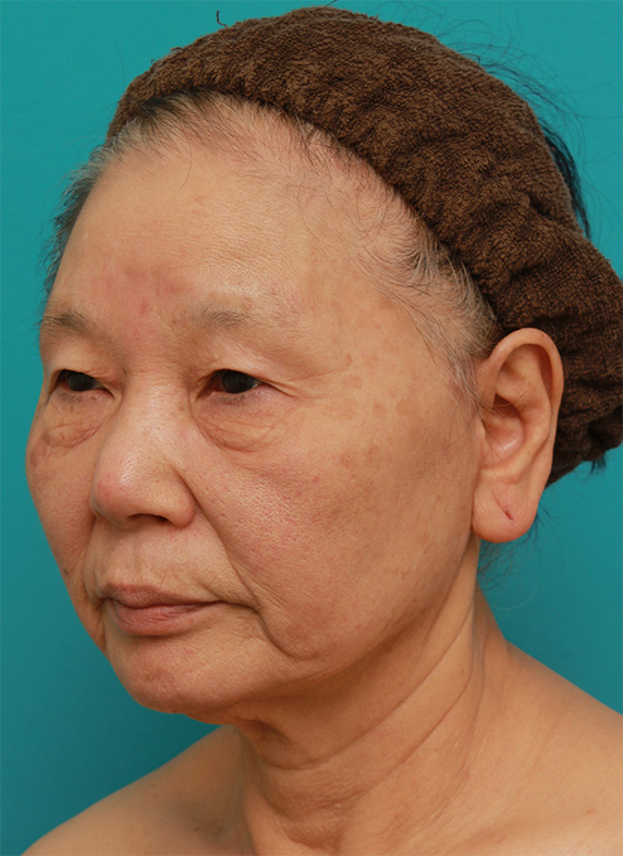 ミニフェイスリフト(頬のたるみ取り),70代女性にミニフェイスリフト(頬のたるみ取り)を行い、頬や首のたるみを改善させた症例 術前術後画像,After(6ヶ月後),ba_minilift22_b.jpg