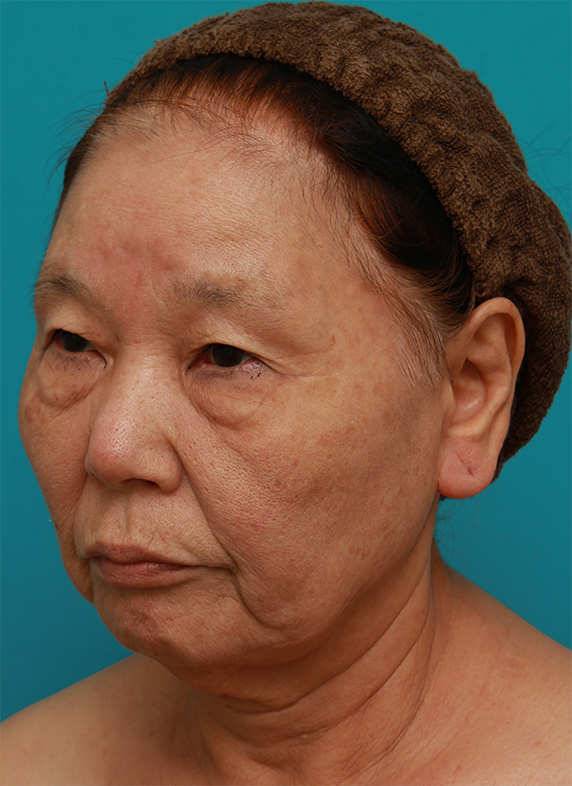 ミニフェイスリフト(頬のたるみ取り),70代女性にミニフェイスリフト(頬のたるみ取り)を行い、頬や首のたるみを改善させた症例 術前術後画像,Before,ba_minilift22_b.jpg