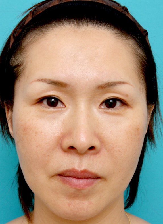 症例写真,ポニーテールリフト(小切開こめかみリフト)の症例 たるみを改善された女性,After,ba_ponytail_pic05_b.jpg