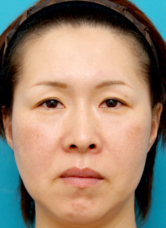 症例写真,ポニーテールリフト(小切開こめかみリフト)の症例 たるみを改善された女性,Before,ba_ponytail_pic05_b.jpg
