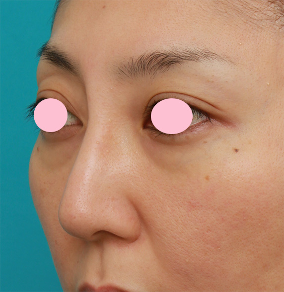 症例写真,眉間から鼻根部、鼻背にかけてシリコンプロテーゼを入れて立体的な顔立ちにした症例写真,After(4ヶ月後),ba_glabella06_b.jpg