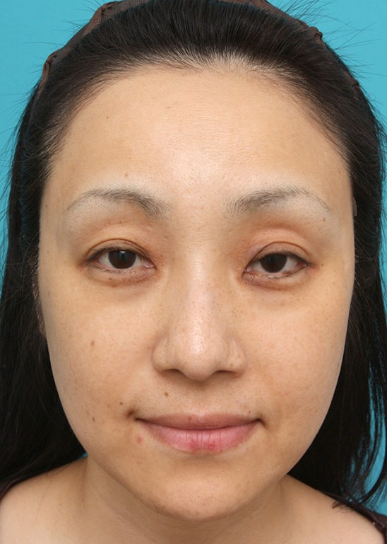症例写真,金の糸(ゴールデンリフト)症例写真,After(6ヶ月後),ba_goldlift_pic10_b.jpg